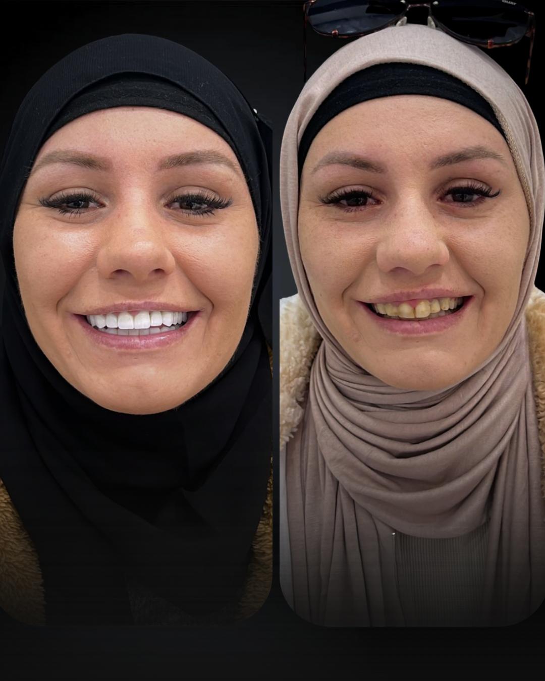Before after 1
