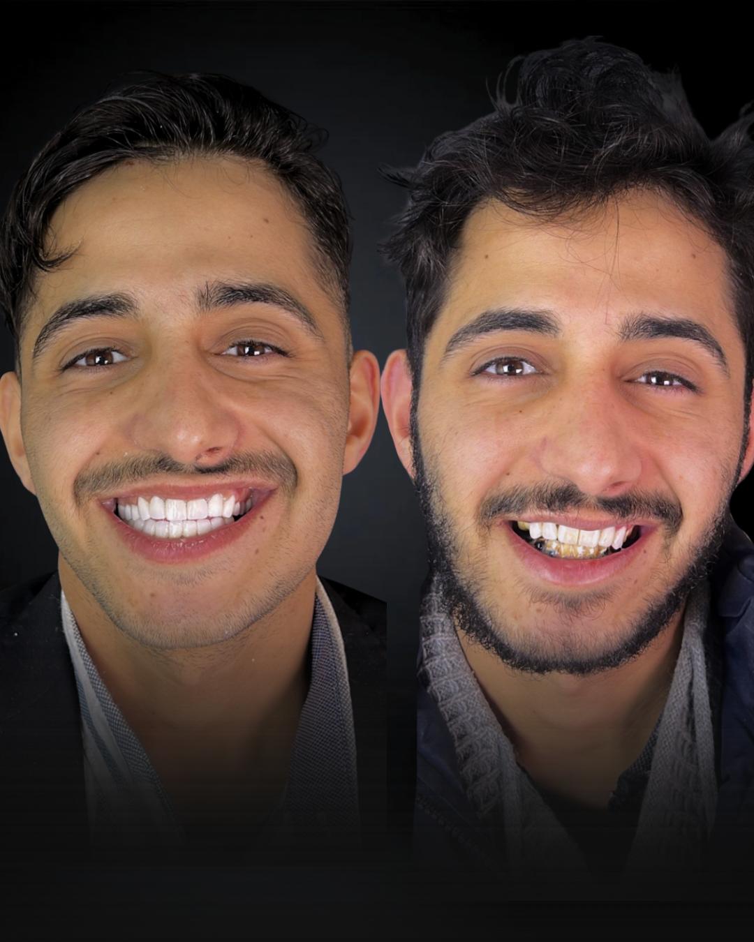 Before after 2