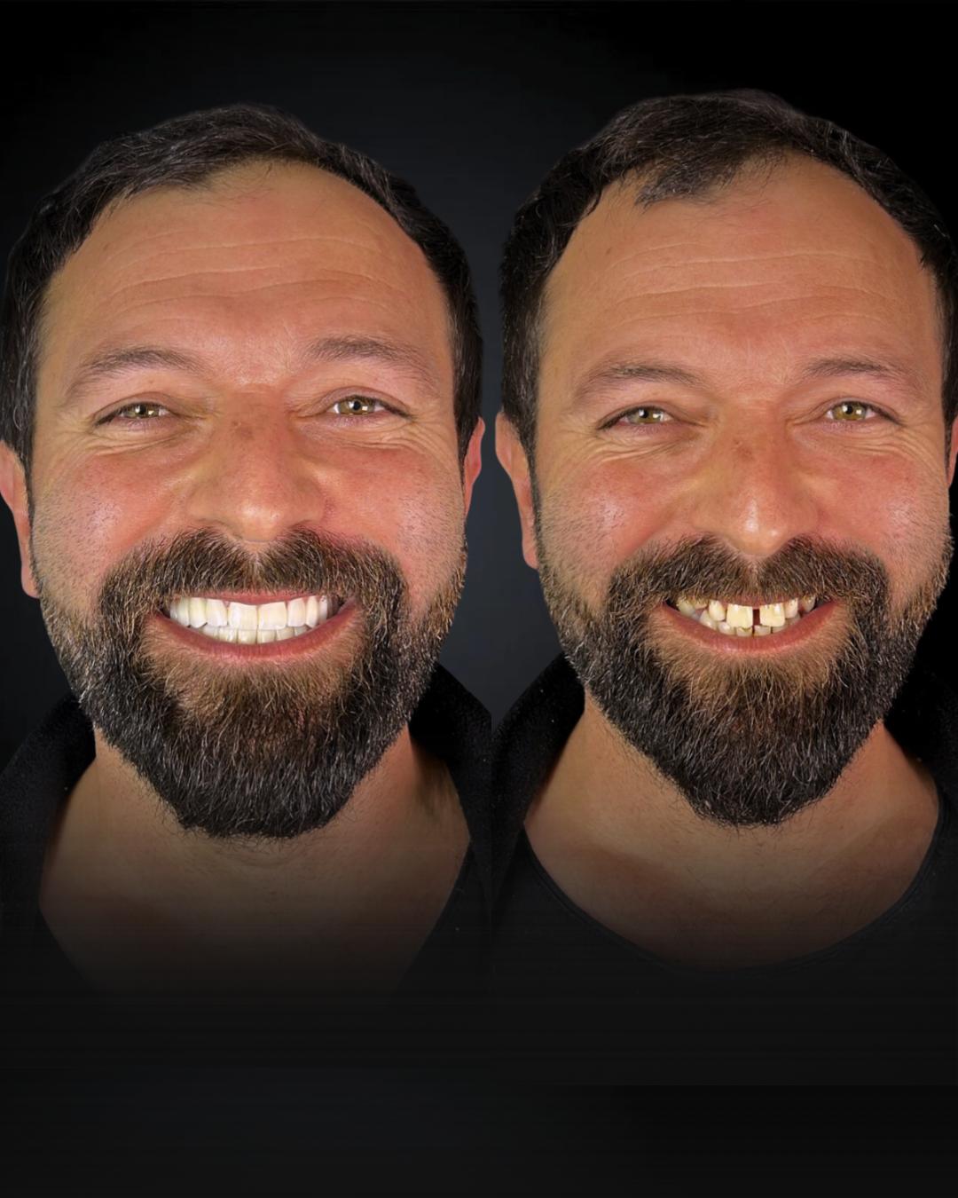 Before after 5
